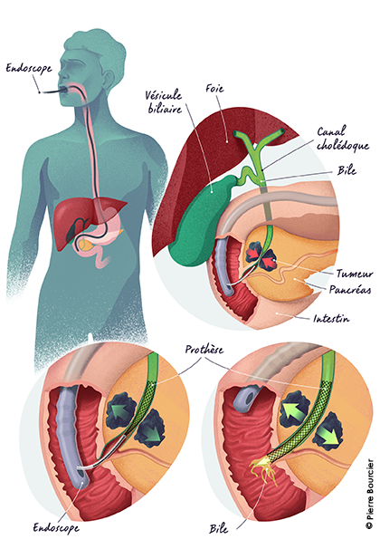 Repr&eacute;sentation de la pose d'une proth&egrave;se biliaire