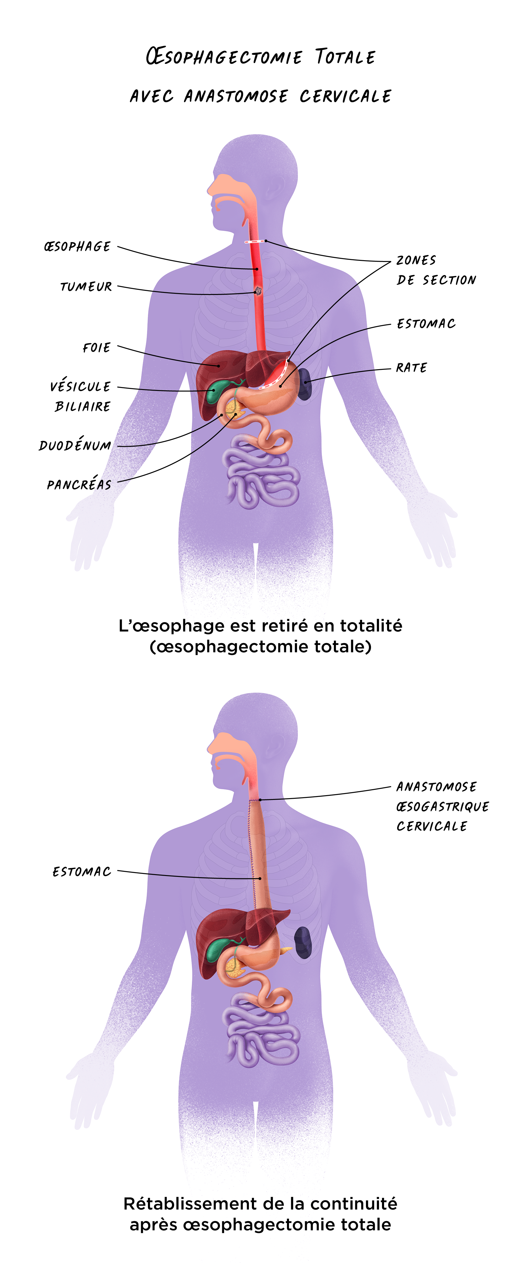 Illustration de l'Œsophagectomie totale