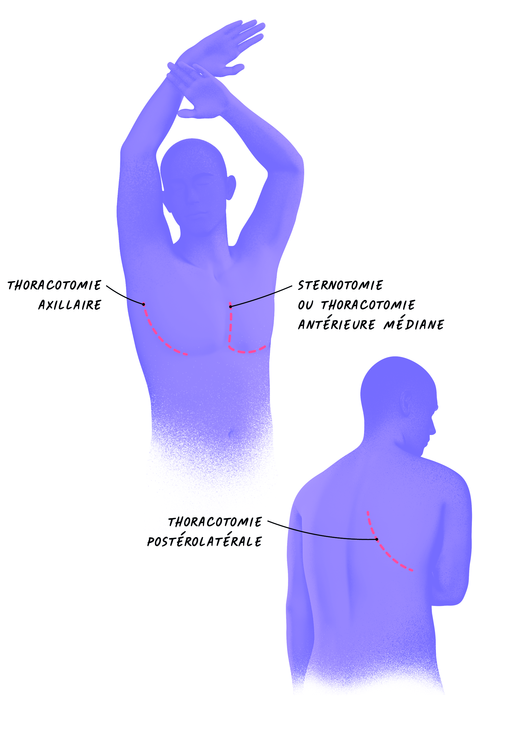 Illustration des incisions &agrave; thorax ouvert