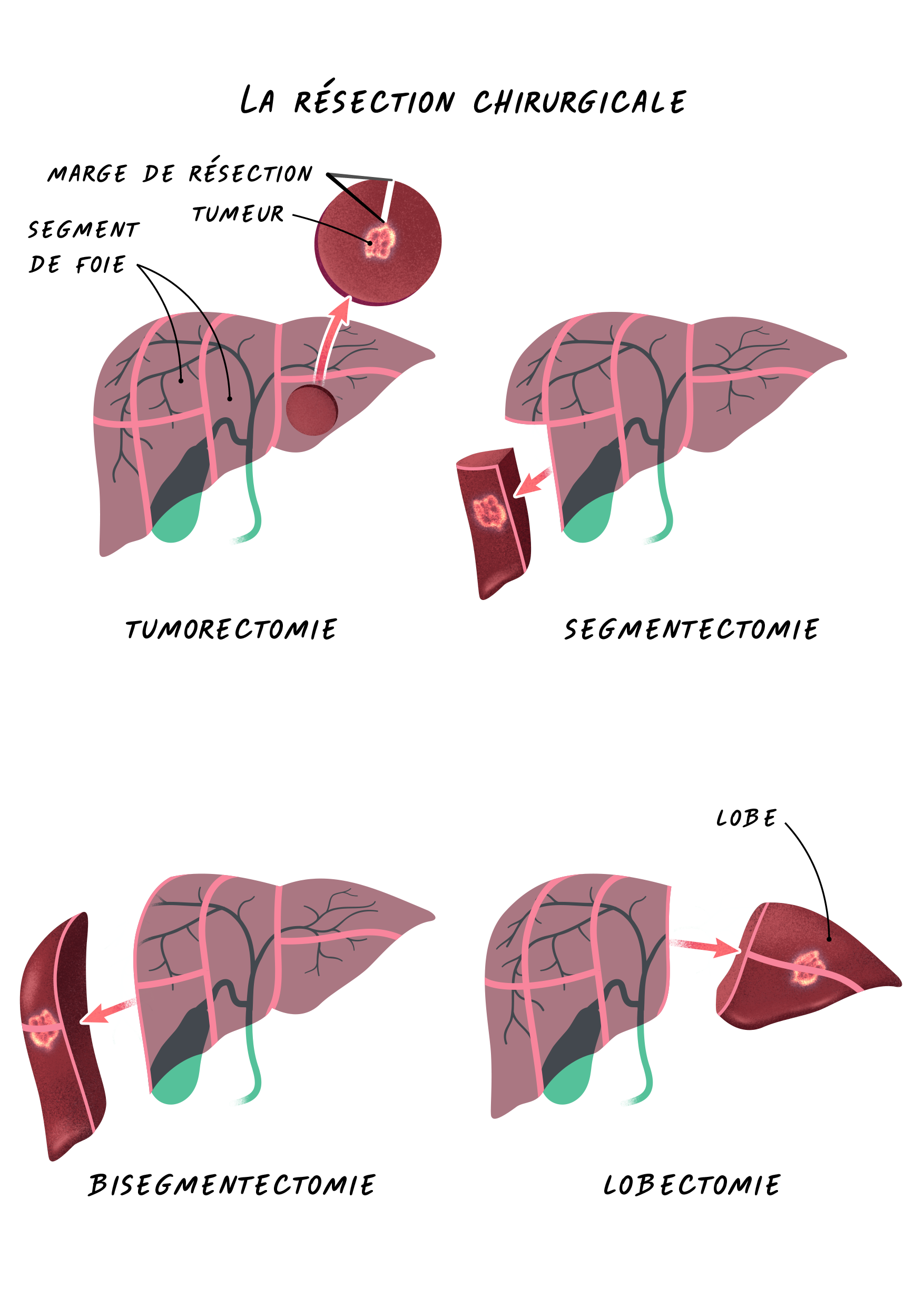 La r&eacute;section chirurgicale
