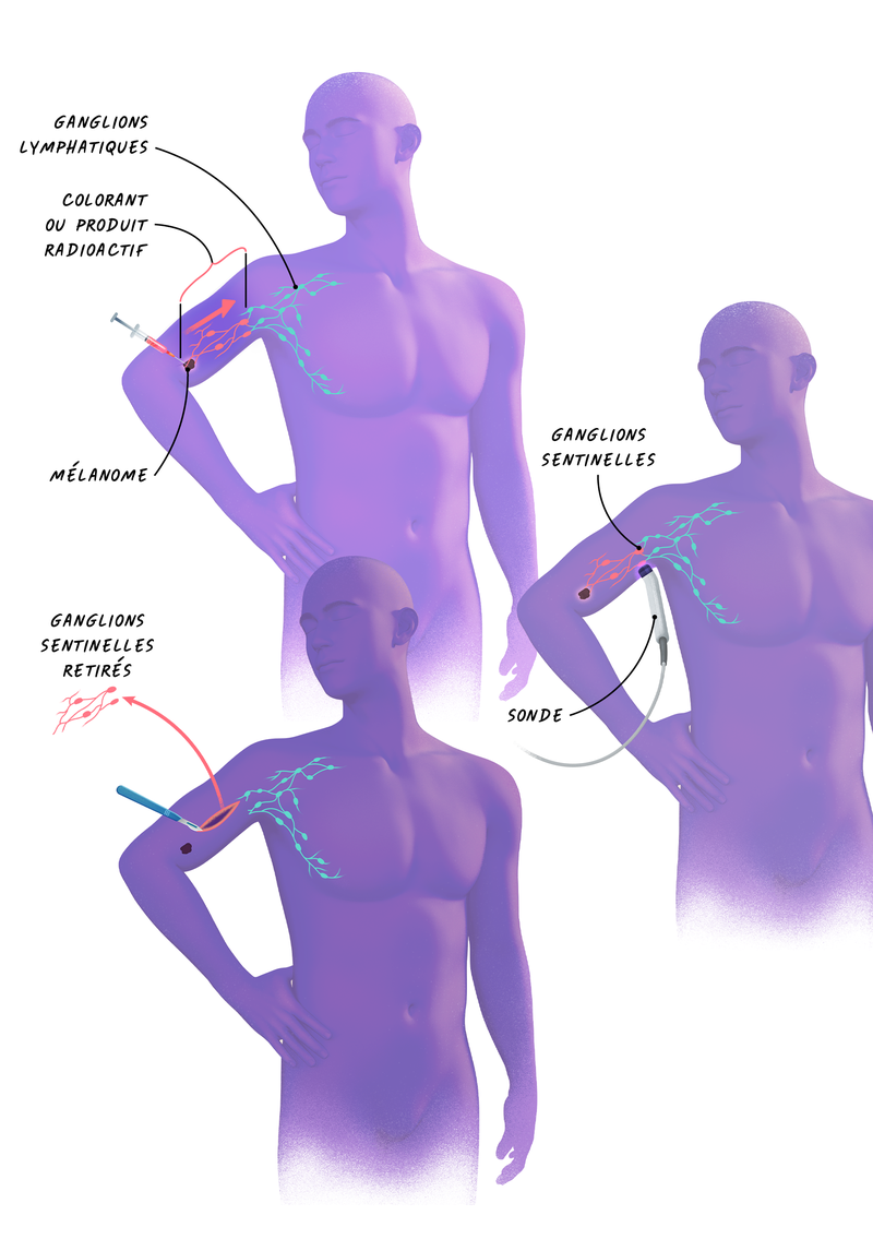 L'ex&eacute;r&egrave;se des ganglions sentinelles