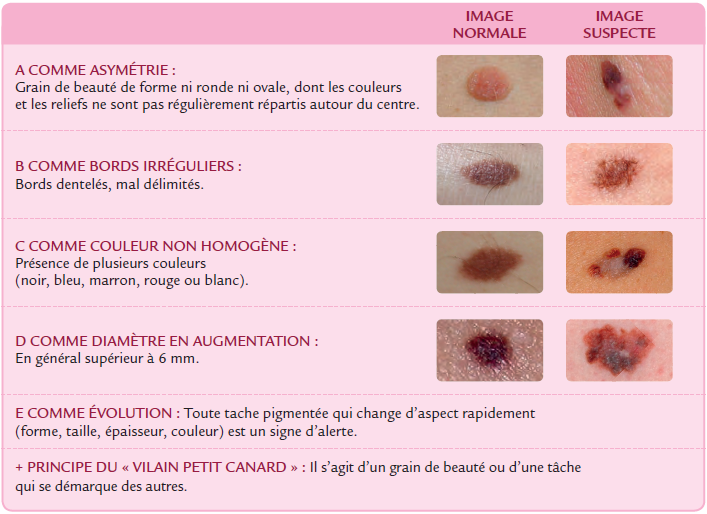 Illustration de la r&egrave;gle ABCDE pour diff&eacute;rencier un m&eacute;lanome d'un naevus