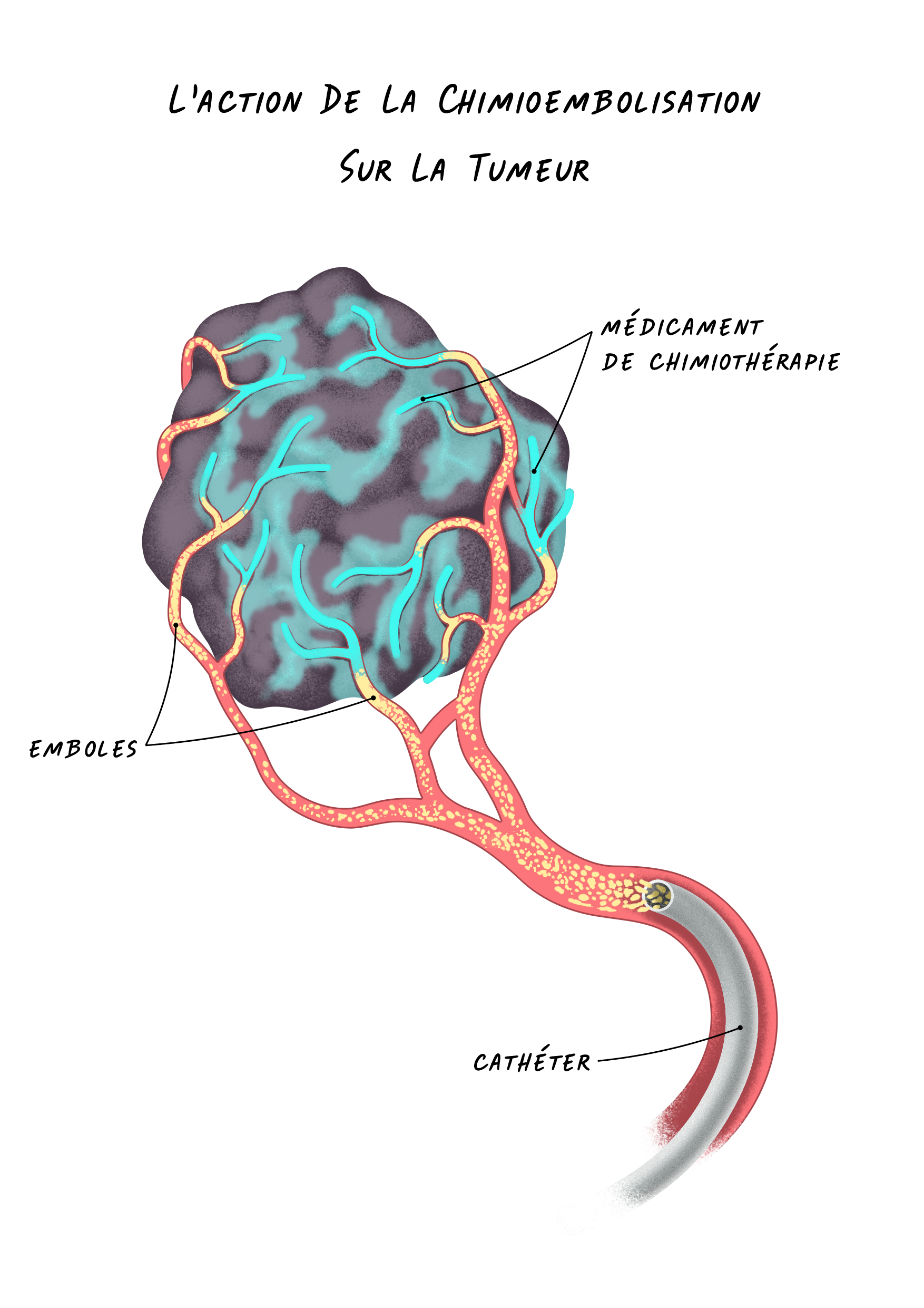 17e Cancers Foie - L'action De La Chimioembolisation Sur La Tumeur.png