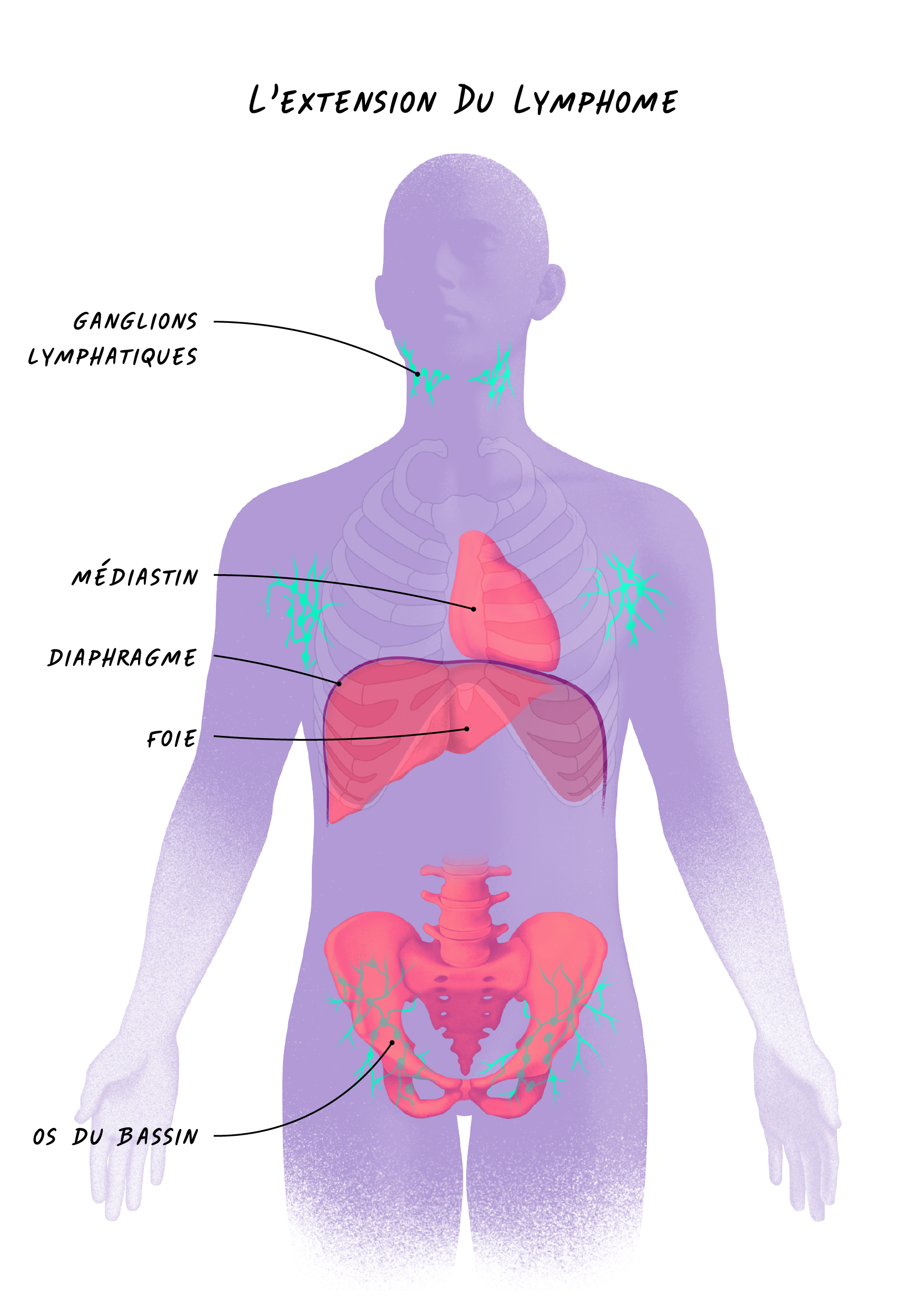28 Lymphome Non Hodgkinien - L'extension Du Lymphome.png