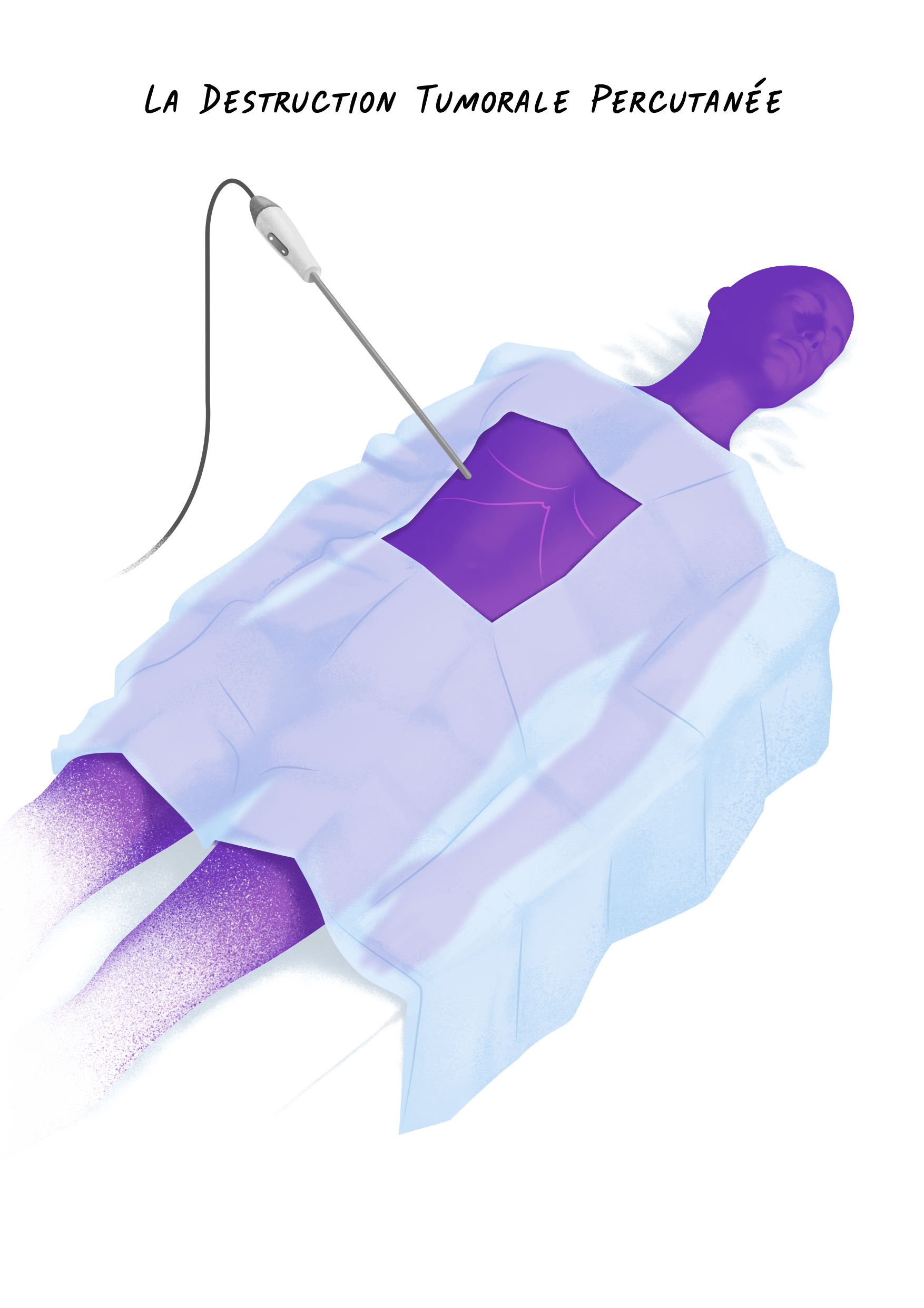 17a Cancers Foie - La Destruction Tumorale Percutan&eacute;e.png