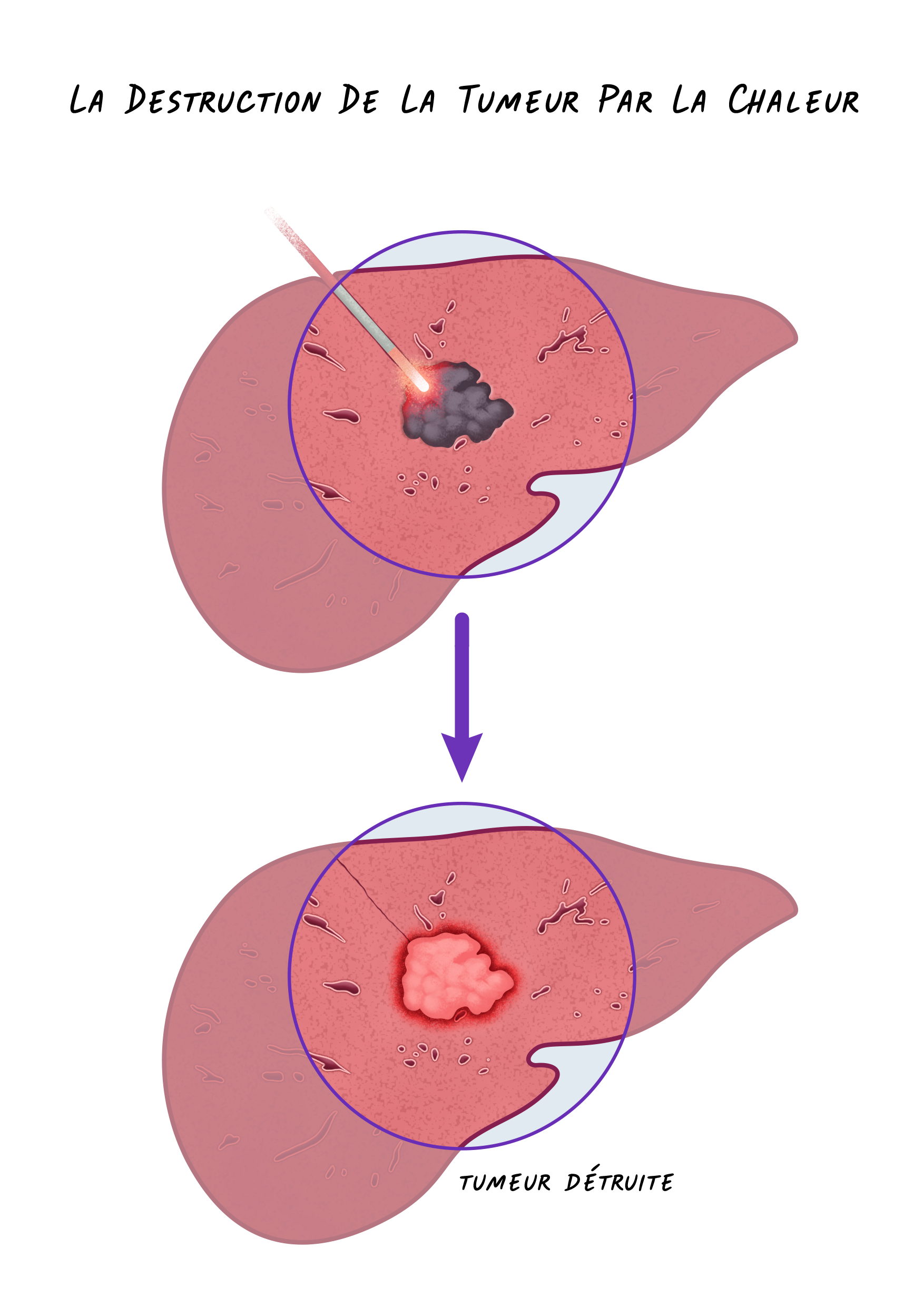 17c Cancers Foie - La Destruction De La Tumeur Par La Chaleur.png